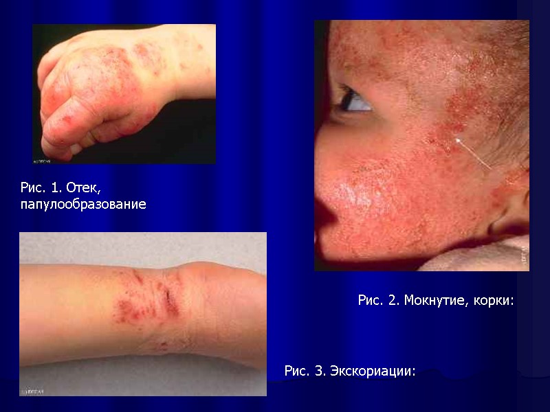 Рис. 1. Отек, папулообразование  Рис. 2. Мокнутие, корки:  Рис. 3. Экскориации: